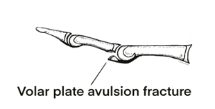 Volar Plate Injury The British Society For Surgery Of The Hand